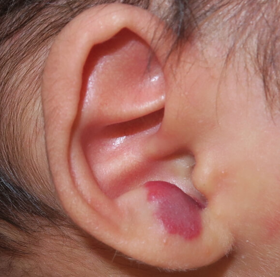 ヘマンジオルシロップ内服例 ：耳のいちご状血管腫です。この状態なら特に治療は必要ありません。 