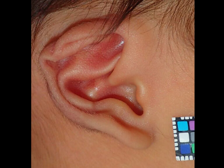 耳たぶ しわ 医師監修 耳たぶ 耳の裏にできる粉瘤の症状と原因 治療方法