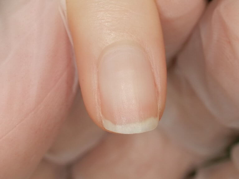 ジェルネイルアレルギー 爪がはがれて、爪の下が厚くなります ふじた形成外科・皮膚科クリニック｜長野県松本市イオンモール晴庭3F｜あざ・しみ